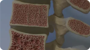 Immagine di copertina per: Dieta per osteoporosi: cosa mangiare per rinforzare le ossa