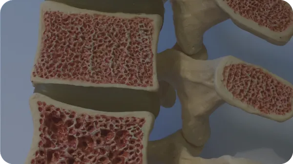 Dieta per osteoporosi: cosa mangiare per rinforzare le ossa